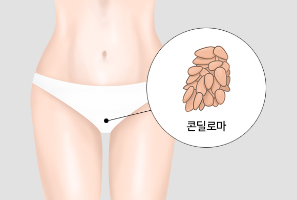 콘딜로마