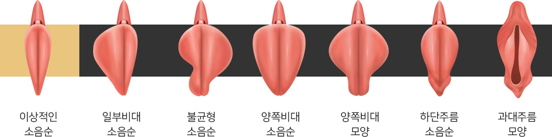 이상적인 소음순 | 일부비대 소음순 | 불균형 소음순 | 양쪽비대 소음순 | 양쪽비대 모양 | 하단주름 소음순 | 과대주름 모양